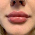 An After Photo of Lip Filler in Seattle and Tacoma