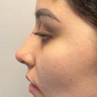 An After Photo of a Non-Surgical Rhinoplasty in Seattle and Tacoma