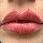 An After Photo of Restylane Kysse Lip Filler in Seattle and Tacoma