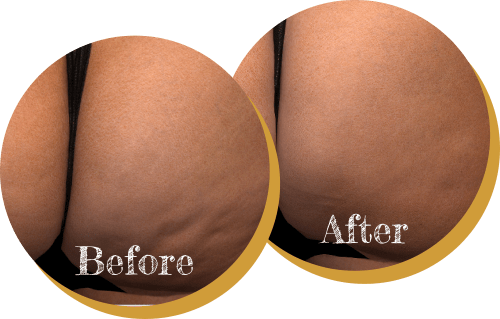 A Before and After of Qwo Treatment