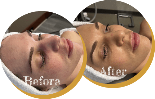 A Before and After Photo of IPL Treatment