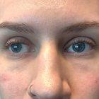 An After Photo of Under Eye Filler In Seattle and Tacoma