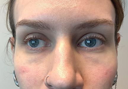 An After Photo of Under Eye Filler In Seattle and Tacoma