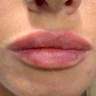 An After Photo of Restylane Kysse Lip Filler in Bellevue and Kirkland