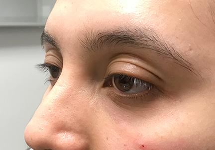 An After Photo of Under Eye Filler in Seattle and Tacoma