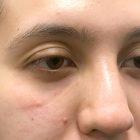 An After Photo of Under Eye Filler in Seattle and Tacoma