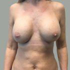 An After Photo of Breast Augmentation Plastic Surgery by Dr. Craig Jonov in Seattle and Tacoma