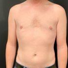 An After Photo of Gynecomastia Plastic Surgery by Dr. Craig Jonov in Seattle and Tacoma