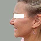 An After Photo of a Facelift Plastic Surgery by Dr. David Santos in Seattle and Tacoma