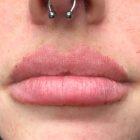 An After Photo of Lip Filler in Seattle and Tacoma