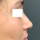 An After Photo of Non-Surgical Rhinoplasty in Seattle and Tacoma