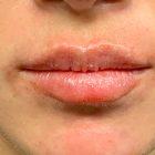 An After Photo of Restylane Kysse Lip Filler in Seattle and Tacoma