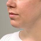 An After Photo of Chin Augmentation Plastic Surgery by Dr. Craig Jonov in Seattle and Tacoma