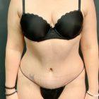 An After Photo of a Tummy Tuck Plastic Surgery by Dr. Craig Jonov in Seattle and Tacoma