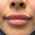 An After Photo of Restylane Lip Fillers in Seattle and Tacoma