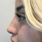 An After Photo of Non-Surgical Rhinoplasty in Seattle and Tacoma