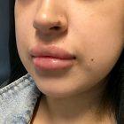 An After Photo of Restylane Kysse Lip Filler in Seattle and Tacoma