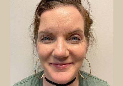 An After Photo of a Facelift and Brow Lift Plastic Surgery by Dr. David Santos in Seattle and Tacoma