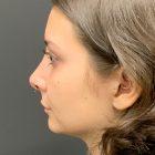 An After Photo of a Rhinoplasty Plastic Surgery by Dr. Craig Jonov in Seattle and Tacoma