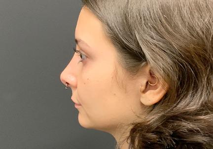 An After Photo of a Rhinoplasty Plastic Surgery by Dr. Craig Jonov in Seattle and Tacoma