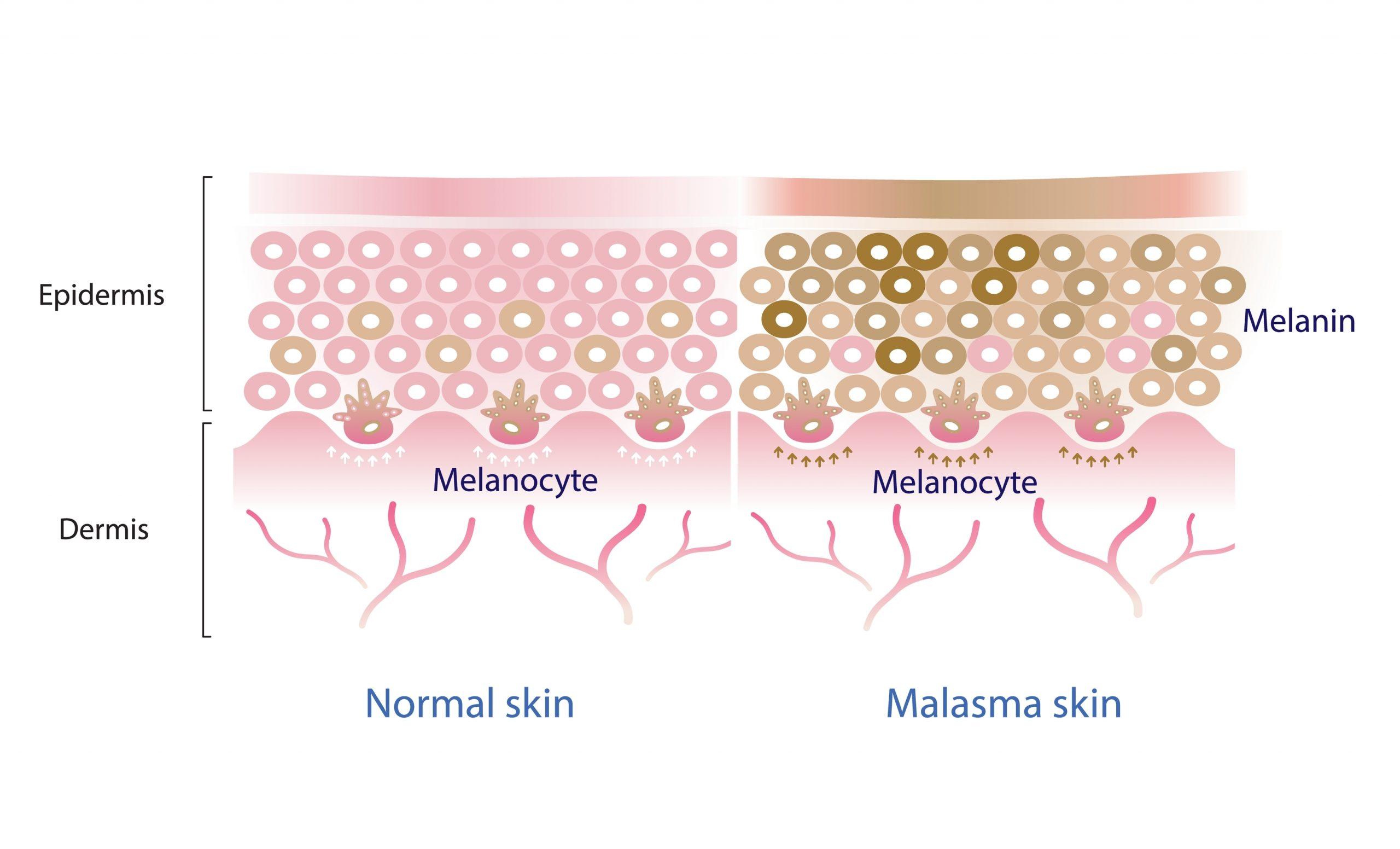 A Graphic Explaining What Melasma Is