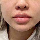 An After Photo of Restylane Kysse Lip Filler in Seattle and Tacoma