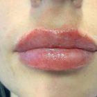 An After Photo of Restylane Kysse Lip Filler in Seattle and Tacoma