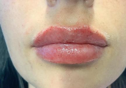 An After Photo of Restylane Kysse Lip Filler in Seattle and Tacoma