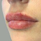 An After Photo of Restylane Kysse Lip Filler in Seattle and Tacoma
