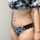 An After Photo of Tummy Tuck Plastic Surgery by Dr. Craig Jonov in Seattle and Tacoma