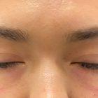 An After Photo of Under Eye Fillers in Seattle and Tacoma