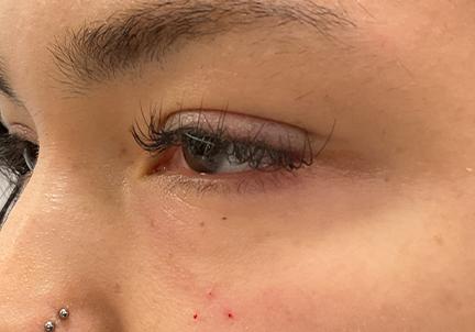 An After Photo of Under Eye Fillers in Seattle and Tacoma