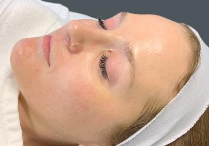 An After Photo of Microneedling in Seattle and Tacoma