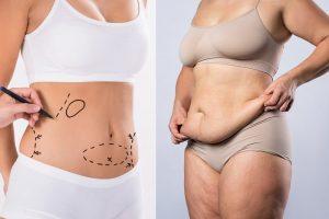 What is The Difference Between Liposuction and Tummy Tuck