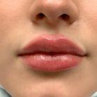 An After Photo of Restylane Kysse Lip Filler in Seattle and Tacoma