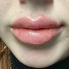 An After Photo of Lip Filler in Seattle and Tacoma