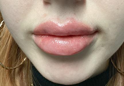 An After Photo of Lip Filler in Seattle and Tacoma