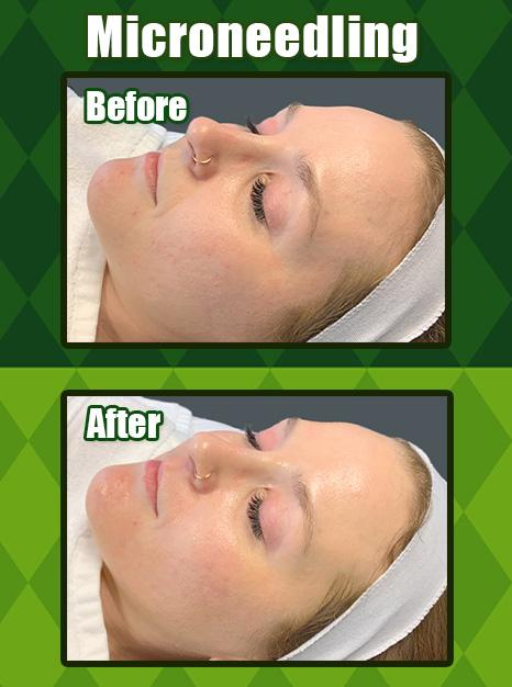 Microneedling Before & After