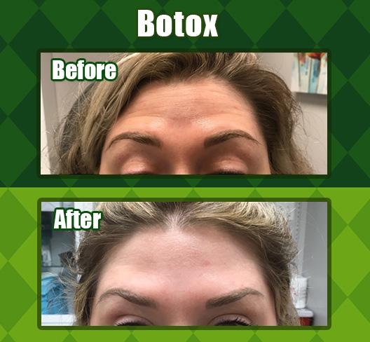 Botox Brow Lift Before & After