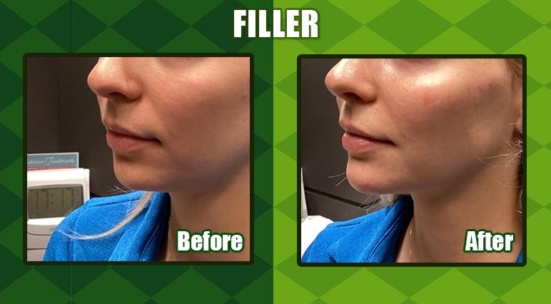 Cheek Filler Before & After