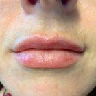 An After Photo of Lip Filler In Seattle and Tacoma