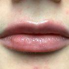 An After Photo of Restylane Kysse Lip Filler in Seattle and Tacoma