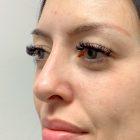 An After Photo of a Non-Surgical Rhinoplasty in Seattle and Tacoma
