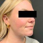 An After Photo of Facial Liposuction Plastic Surgery by Dr. Craig Jonov in Seattle and Tacoma