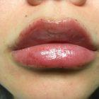 An After Photo of Lip Filler by Dr. K in Seattle and Tacoma