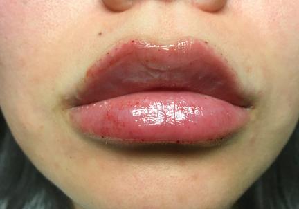 An After Photo of Lip Filler by Dr. K in Seattle and Tacoma