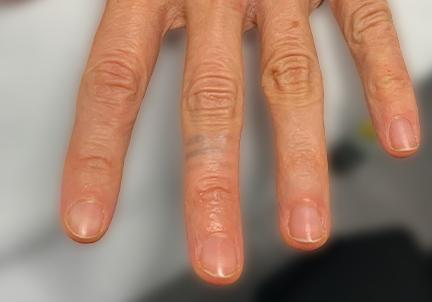 An After Photo of Laser Tattoo Removal in Seattle and Tacoma
