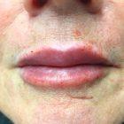 An After Photo of Lip Filler in Seattle and Tacoma