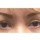 An After Photo of Upper & Lower Blepharoplasty Plastic Surgery by Dr. David Santos in Seattle and Tacoma