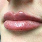 An After Photo of Lip Filler Injections by Dr. K in Seattle and Tacoma